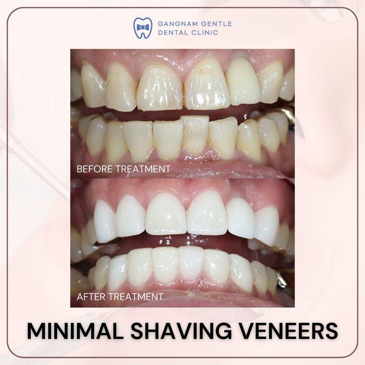 Minimales Beschleifen, maximale Wirkung. Entdecken Sie die Schönheit unserer Veneer-Lösungen anhand unserer neuesten Vorher-Nachher-Ergebnisse.