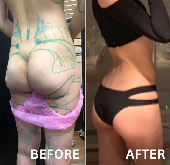 Lydian Plastic Surgery Clinic before and after image