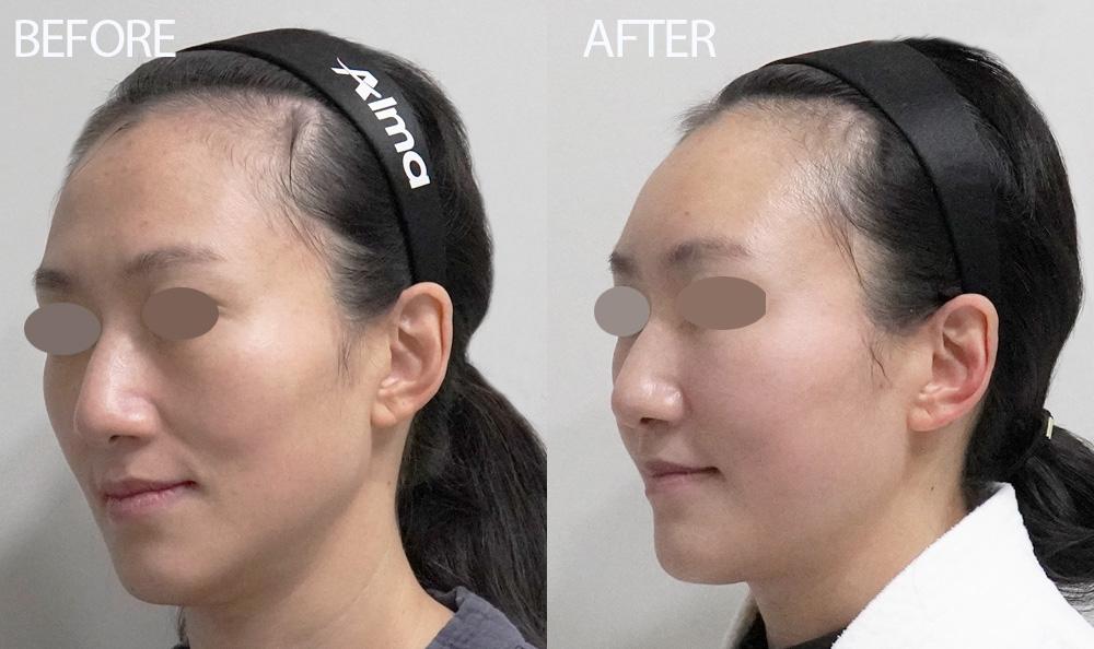 cost stem cell facial korea