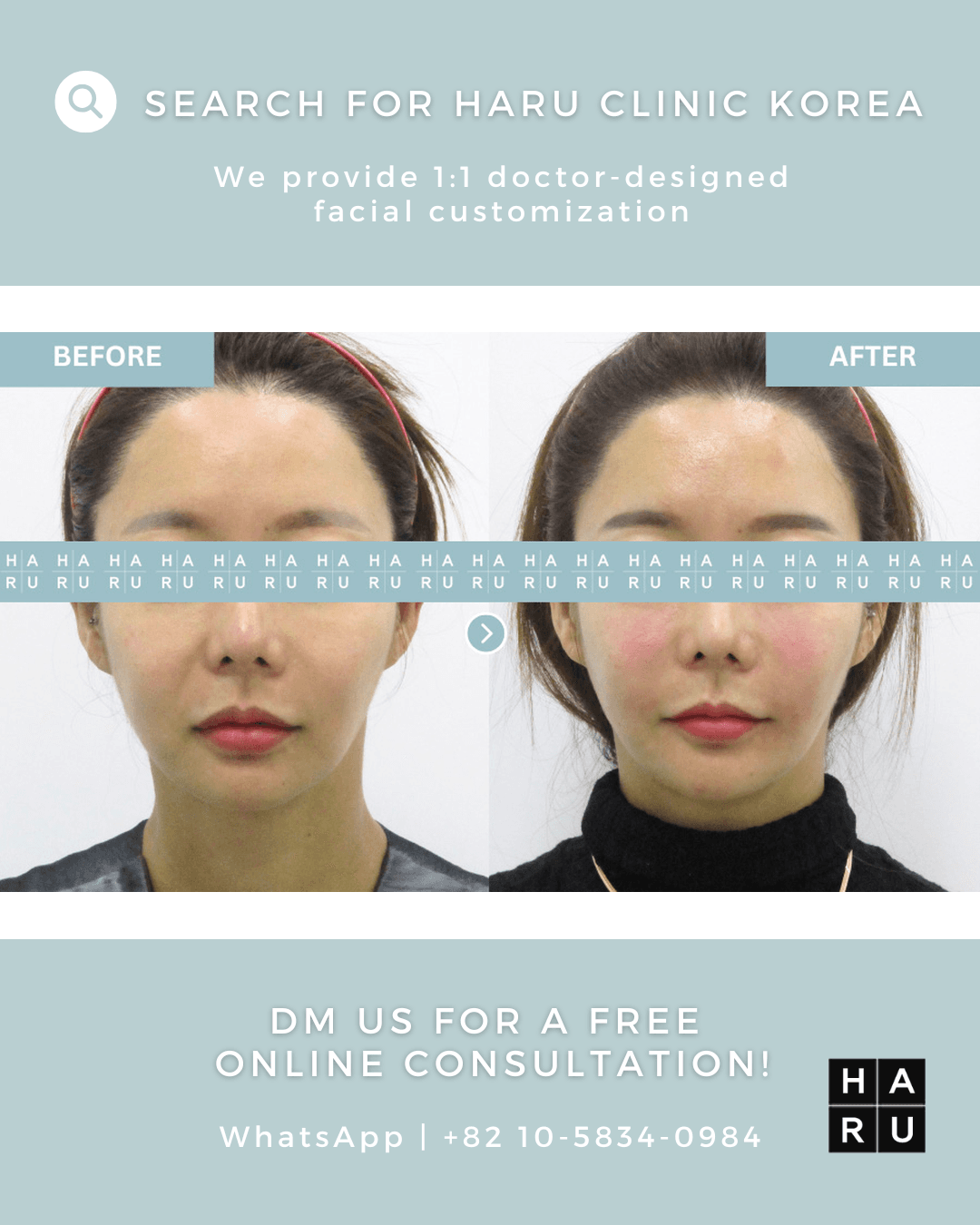 Lippenfiller, Mundwinkel-Lift mit Botox