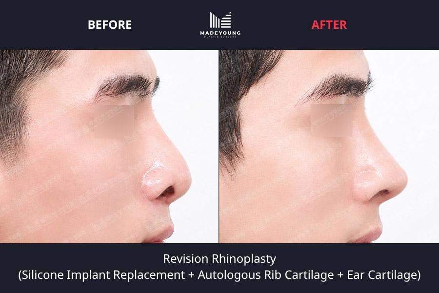 Rhinoplasty silicone implant replacement autologous rib cartilage ear cartilage