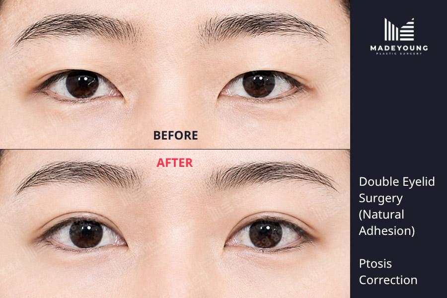 Eyelid surgery natural adhesion ptosis correction