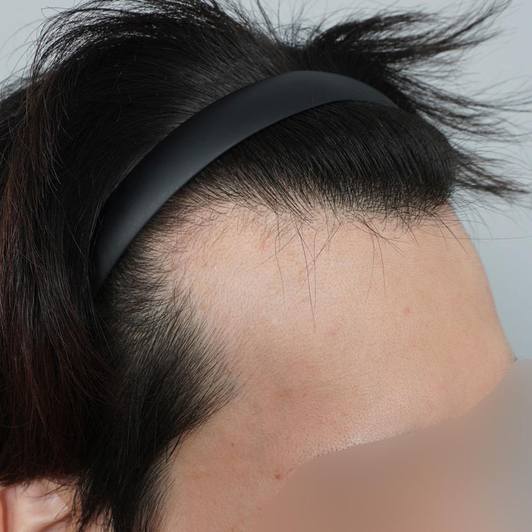 Hair Transplant on Scar 	•	Additional Treatment: PRP Hair Loss Treatment 	•	After: 267 days post-op 	•	Details: 3,300 grafts (hairline, M-shape, temples) + PRP