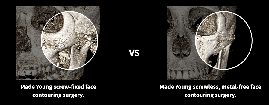 cost cheekbone reduction korea