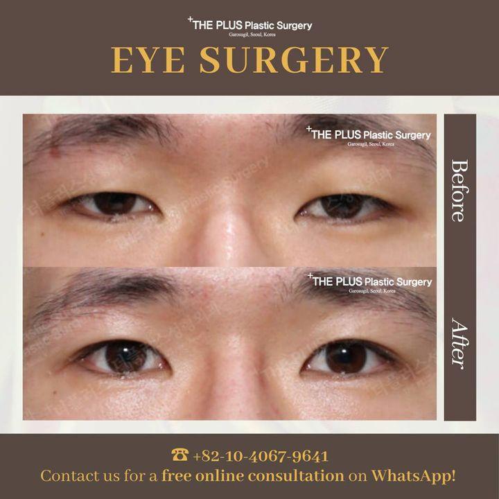 See the difference with eye surgery at ThePlus. Our before and after photos highlight the precision and care we provide to achieve brighter, more youthful eyes.