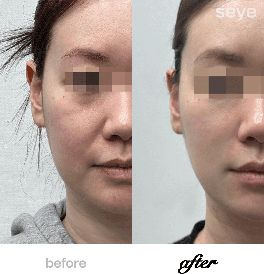 Before and After Thread Lift