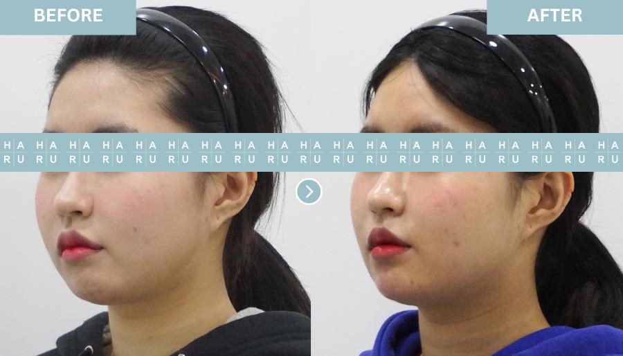 Before and After Chin Botox