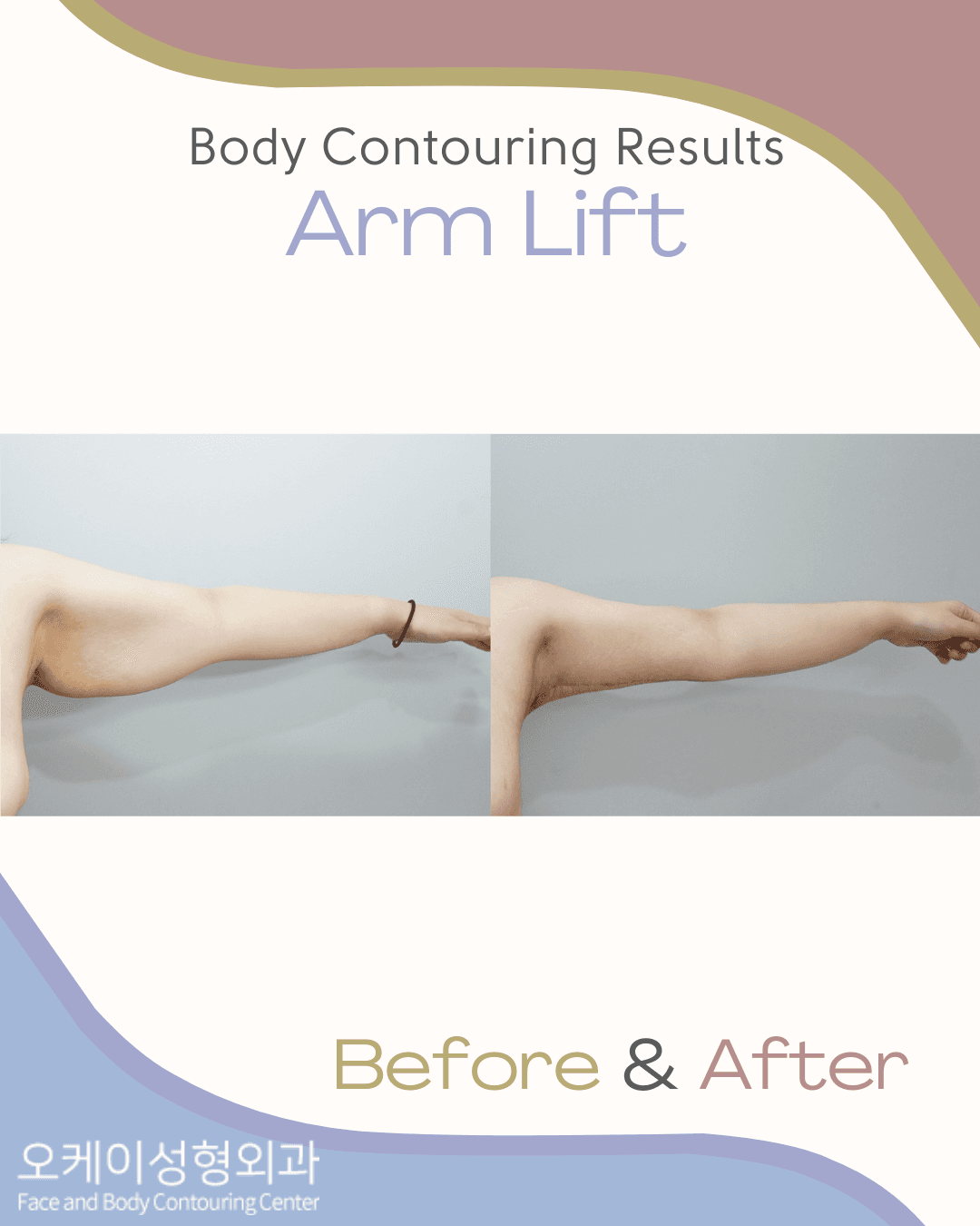 Okay Plastic Surgery Clinic before and after image