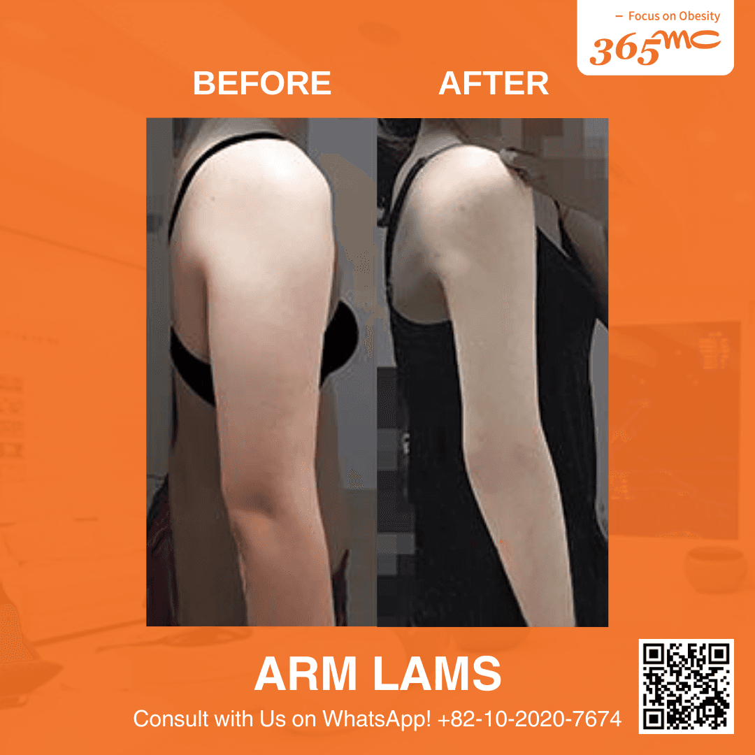 bna-arm-lams 3.png