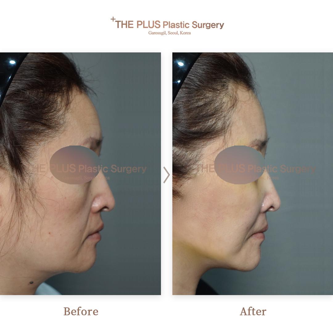 Face contouring + Mini Face Lifting