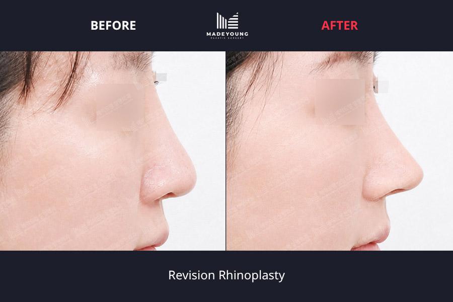 Rhinoplasty