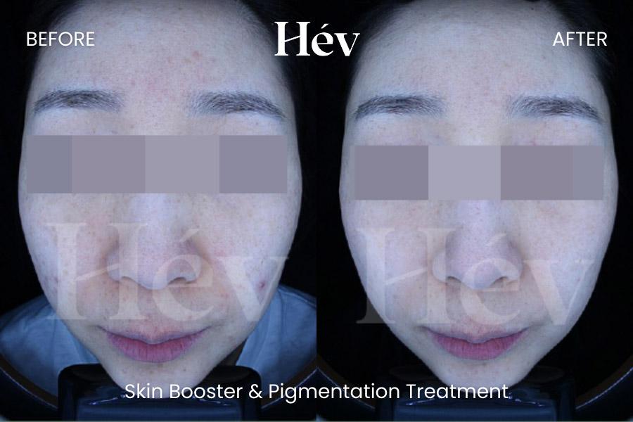 glutathione injection in korea with sunday open Skin Booster Korea: Materials, Results, Recovery and Travel Planning Foods