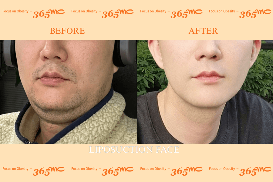 Liposuction - face