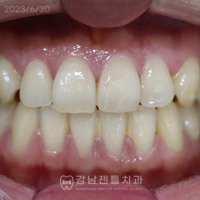 Before Teeth Whitening