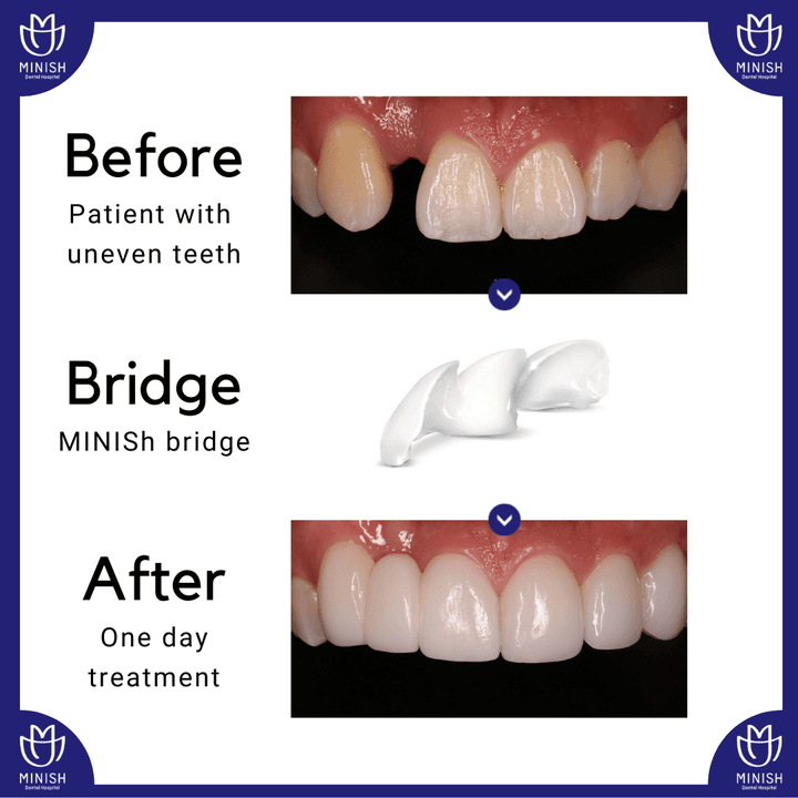 At MINISH we use a newly designed bridge which is bonded to the teeth on either side which means teeth feel like and natural.   #dentalbridge #minishbridge #minishdental #bridgeseoul #dentalbridge
