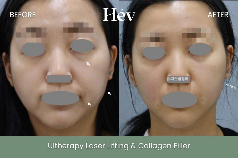 Before and After Ultherapy Lifting