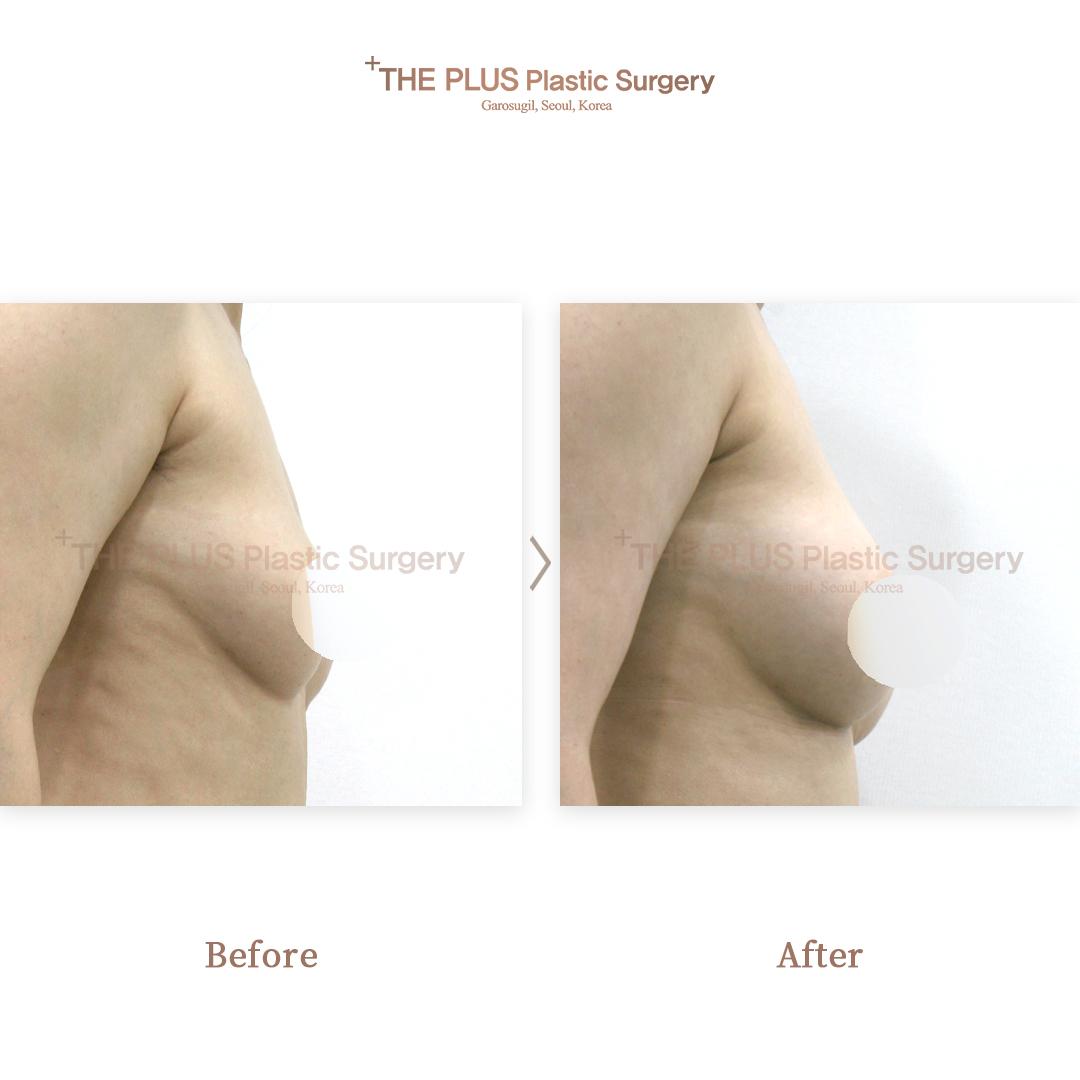 Breast augmentation by autologous fat grafting