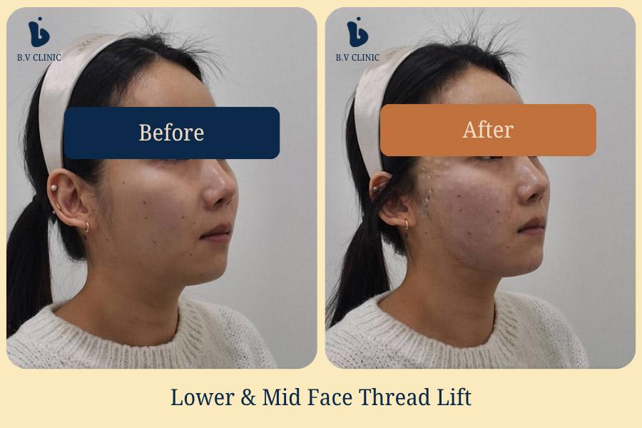 Before and After Thread Lift