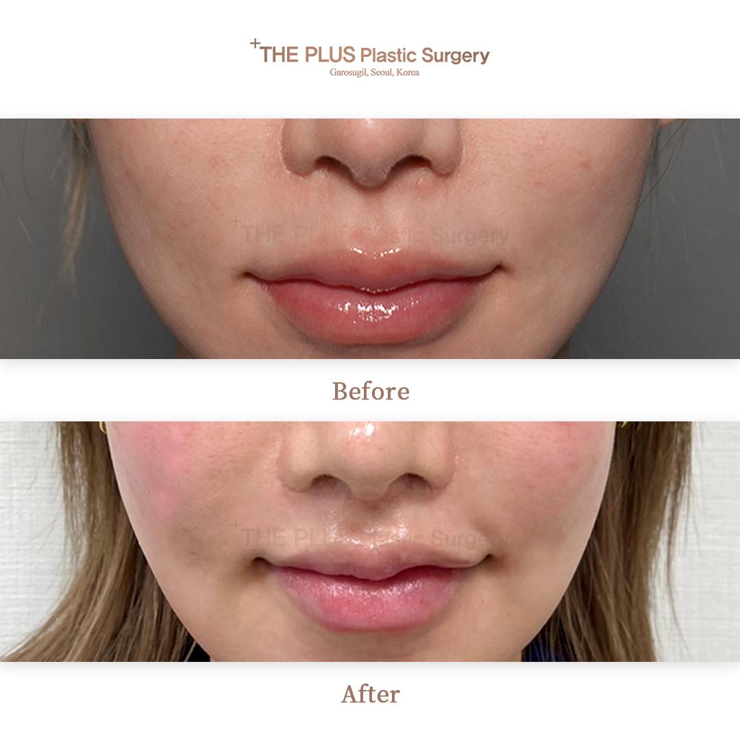 Before and After Bullhorn-Lip-Lift