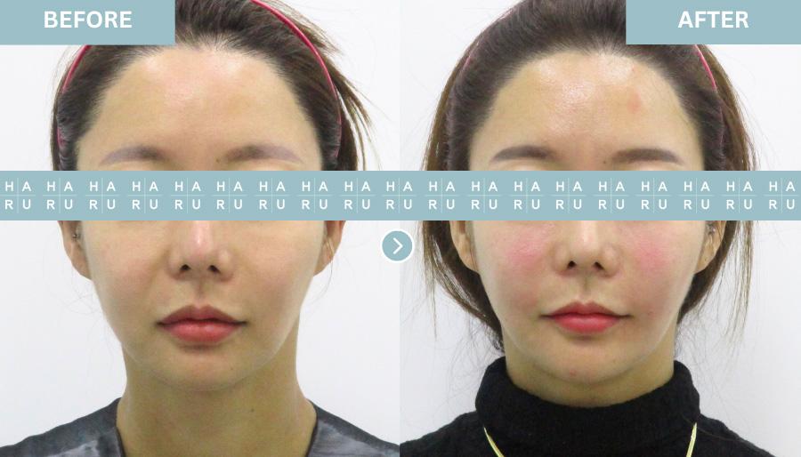 Before and After Lip Fillers