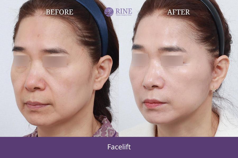 Before and After Face Lift