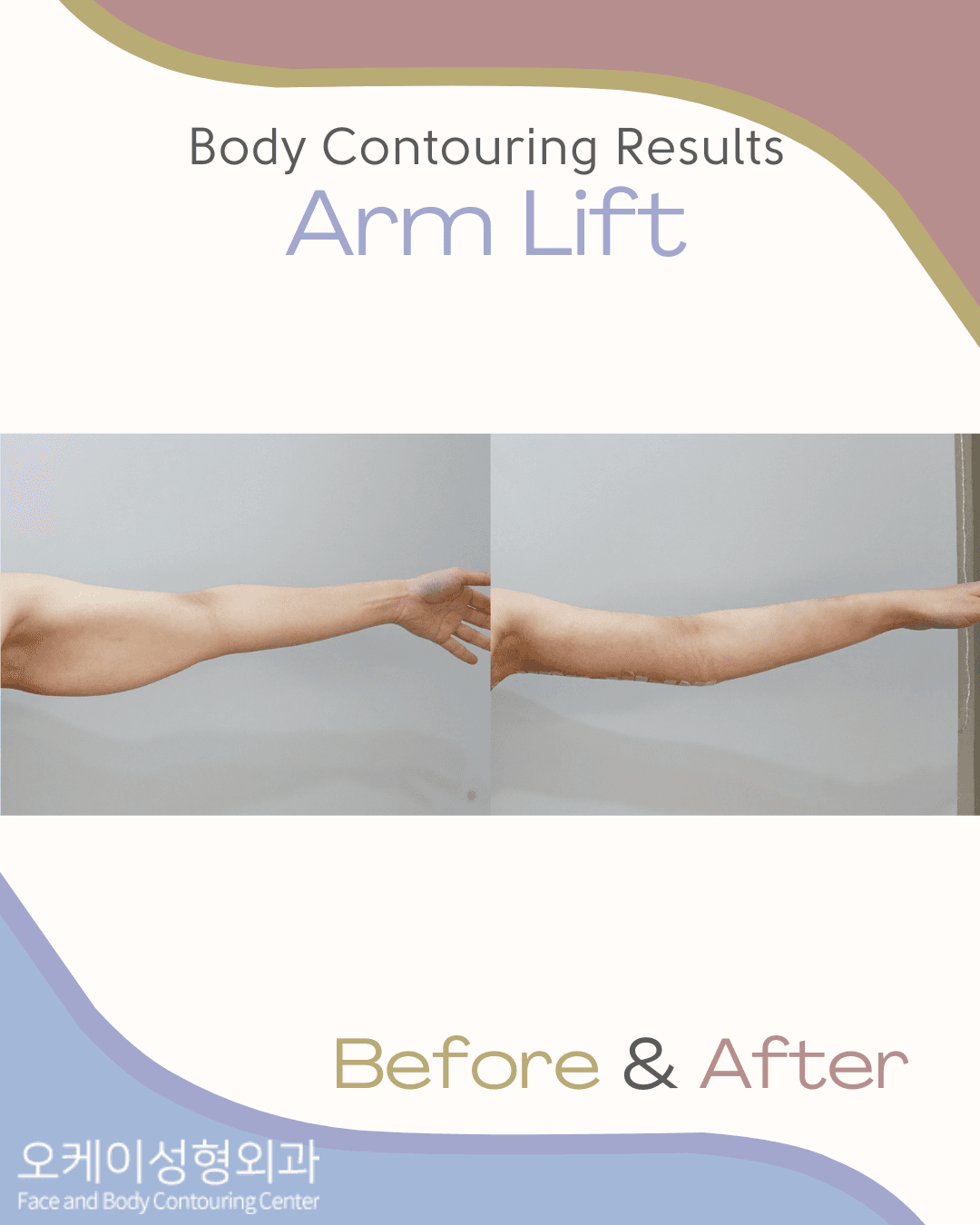 Okay Plastic Surgery Clinic before and after image