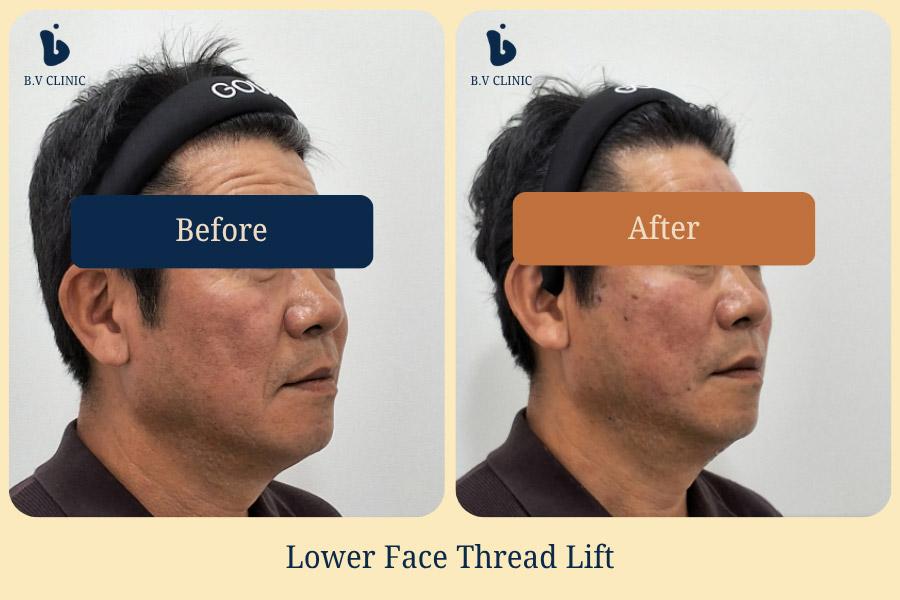 Before and After Thread Lift