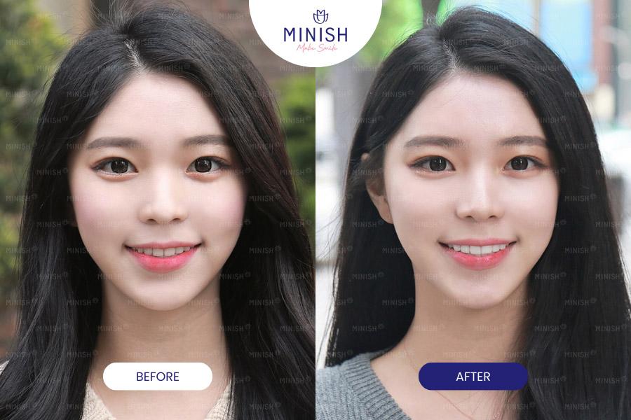 Before and After All-ceramic Veneers