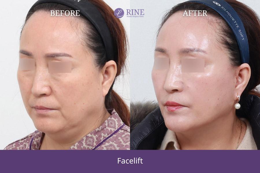 Before and After Face Lift