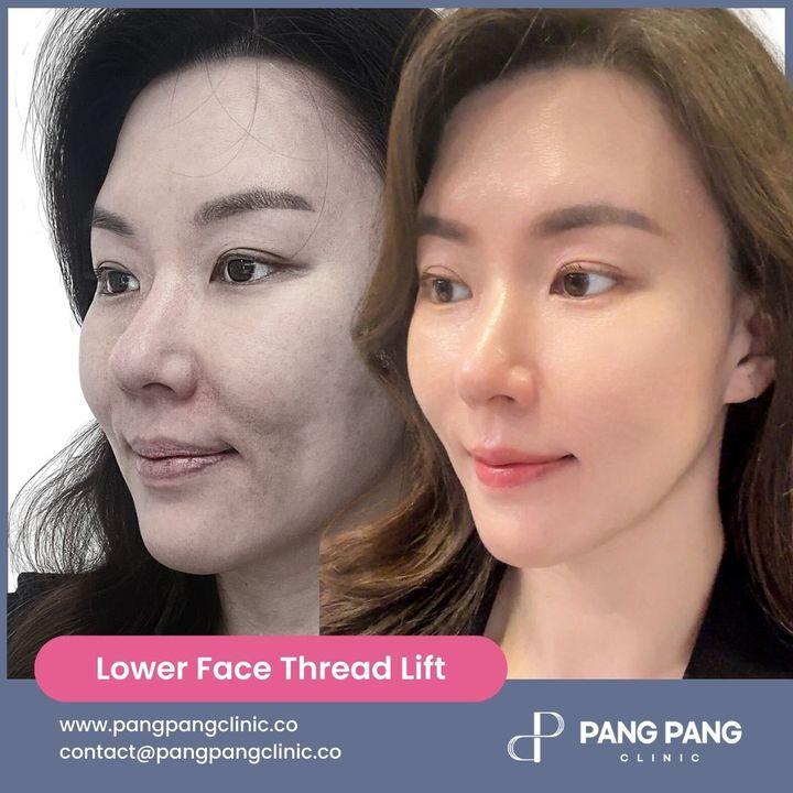 sagging neck skin treatment korea