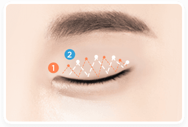 Double Eyelid Surgery