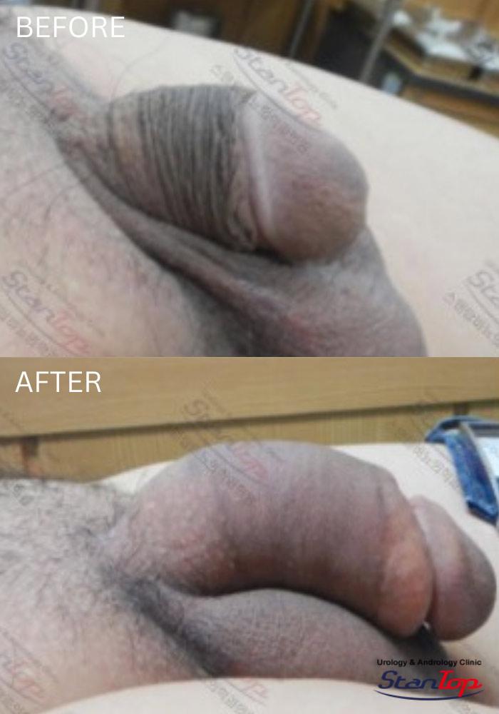 Stantop Penis Lengthening