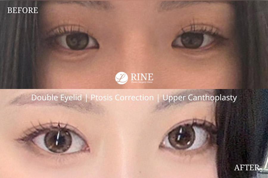 Double Eyelid ptosis correction upper canthoplasty