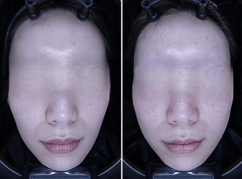 Before and After Collagen Filler