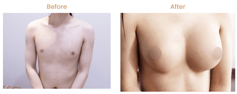 Transgender breast implant Korea before after
