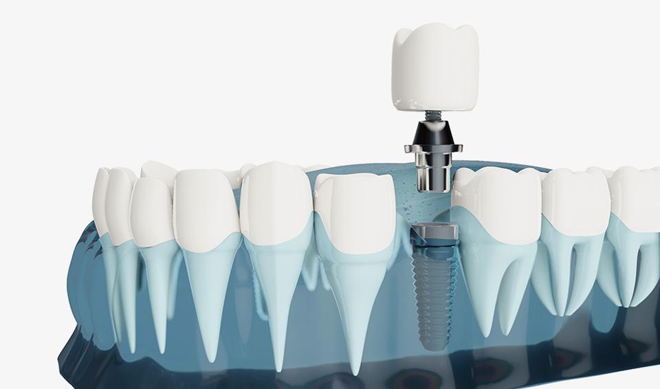 Implant