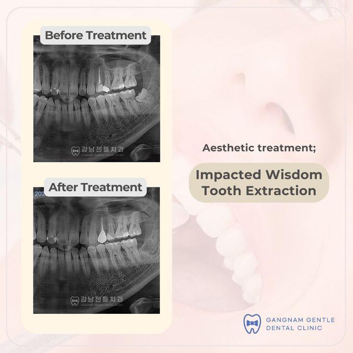 Wisdom tooth extraction: Don't let impacted wisdom teeth ruin your smile. Our experienced dentists can help you get the best possible results. Schedule your appointment today! ^^  Wisdom tooth extraction is a common dental procedure performed when the third molars, known as wisdom teeth, cause issues such as impaction, crowding, pain, infection, or other dental problems.