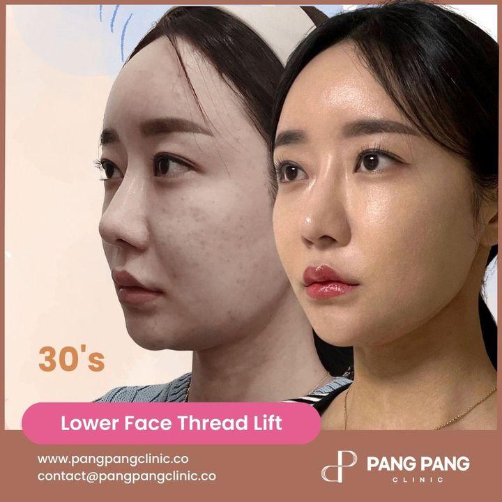 sagging neck skin treatment korea