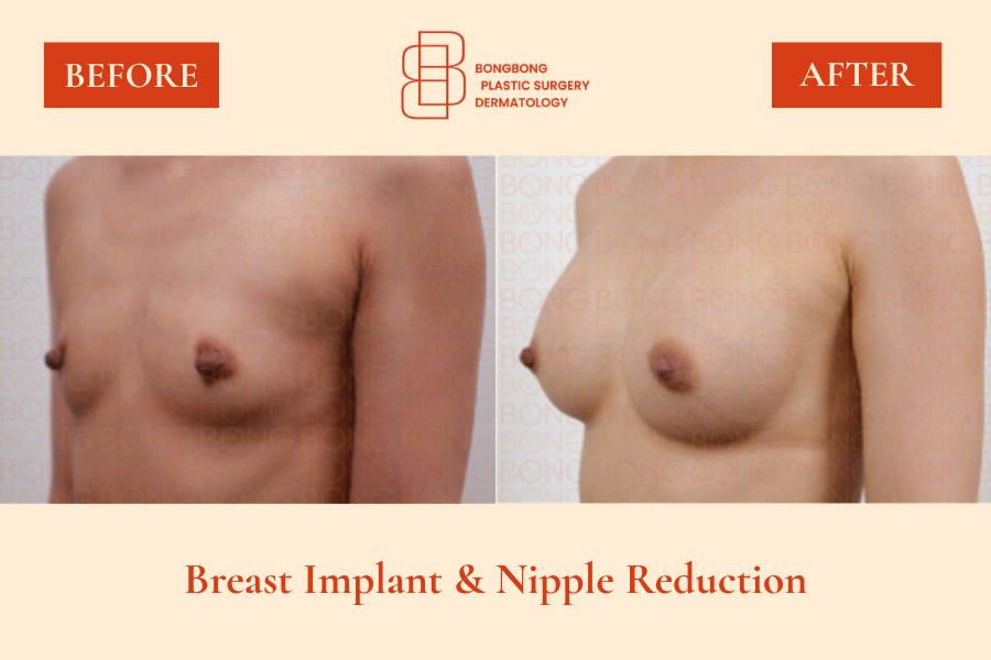 Before and After Breast Augmentation