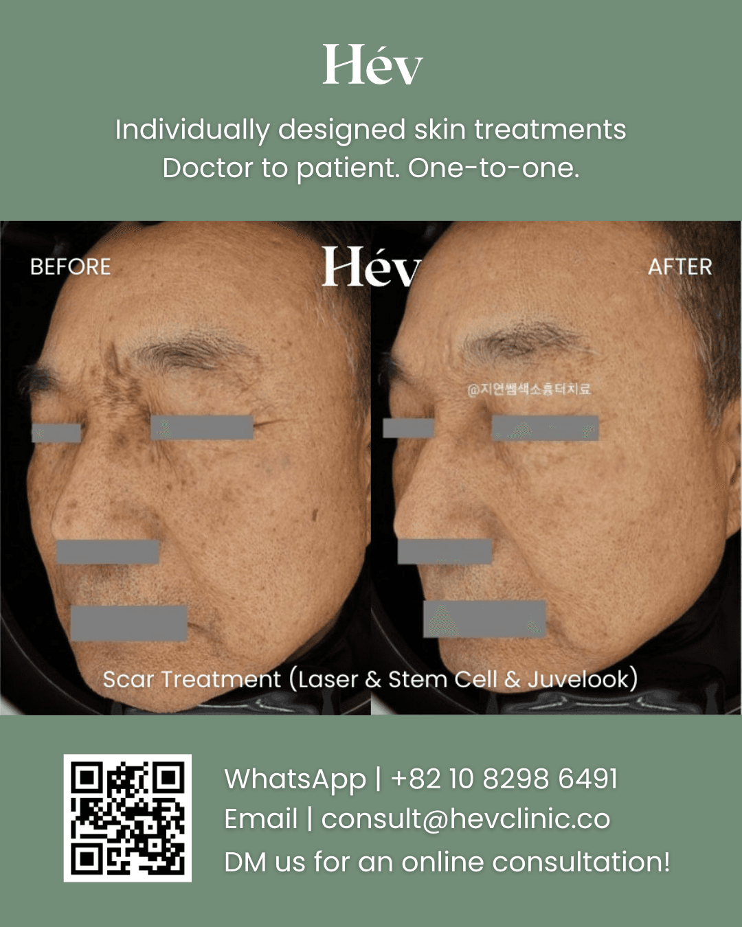 Scar Removal Laser, Stem Cell Facial