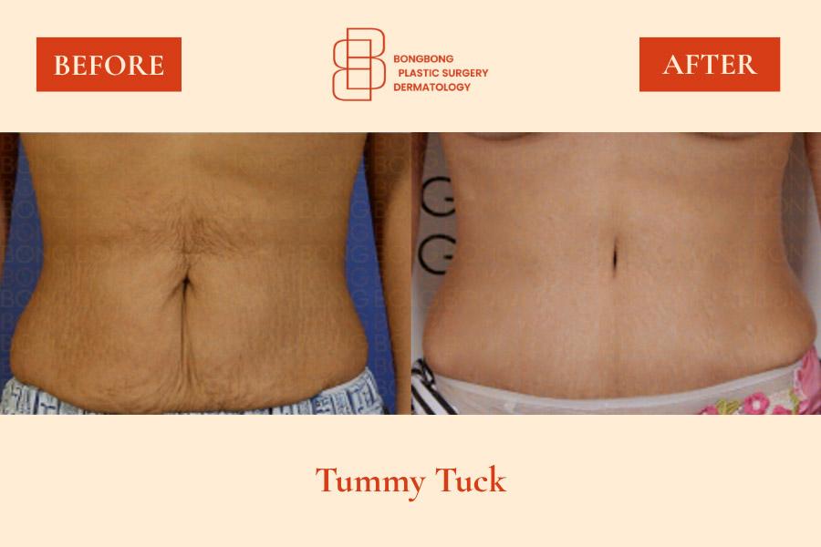Before and After Tummy Tuck