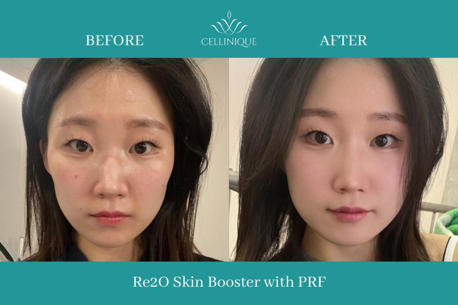 Re2O Skin Booster mit PRF