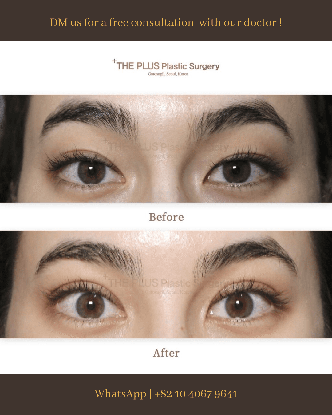 Ptosis Correction
