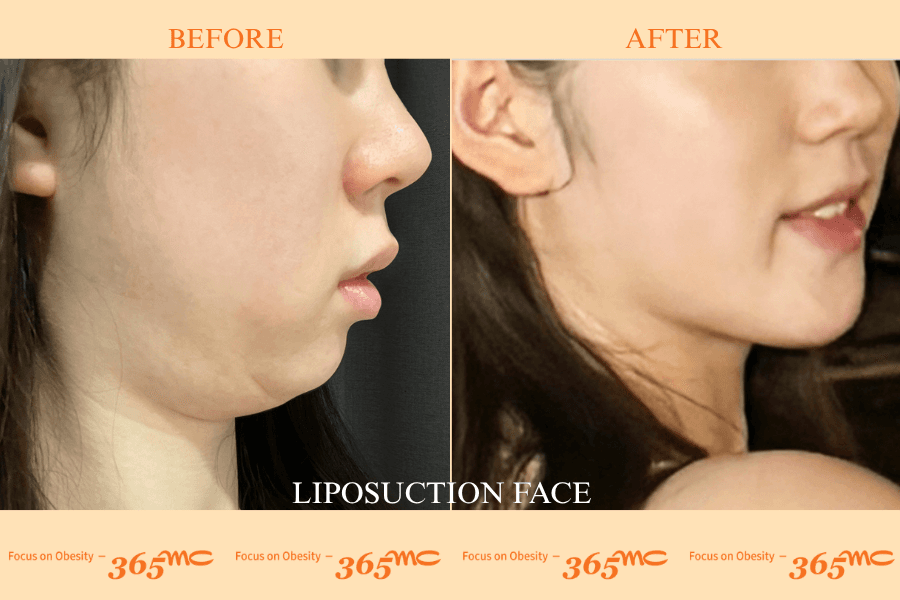 Liposuction - face
