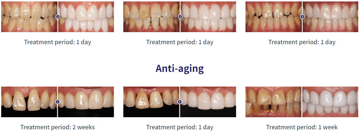 Veneers