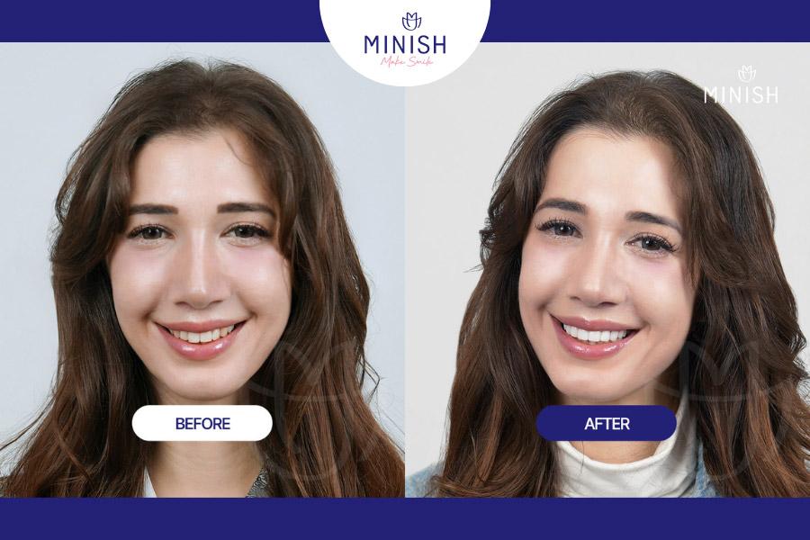 Before and After All-ceramic Veneers