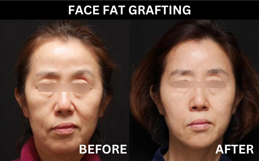 full face fat grafting in korea