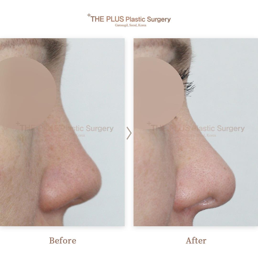 THEPLUS Plastic Surgery before and after image