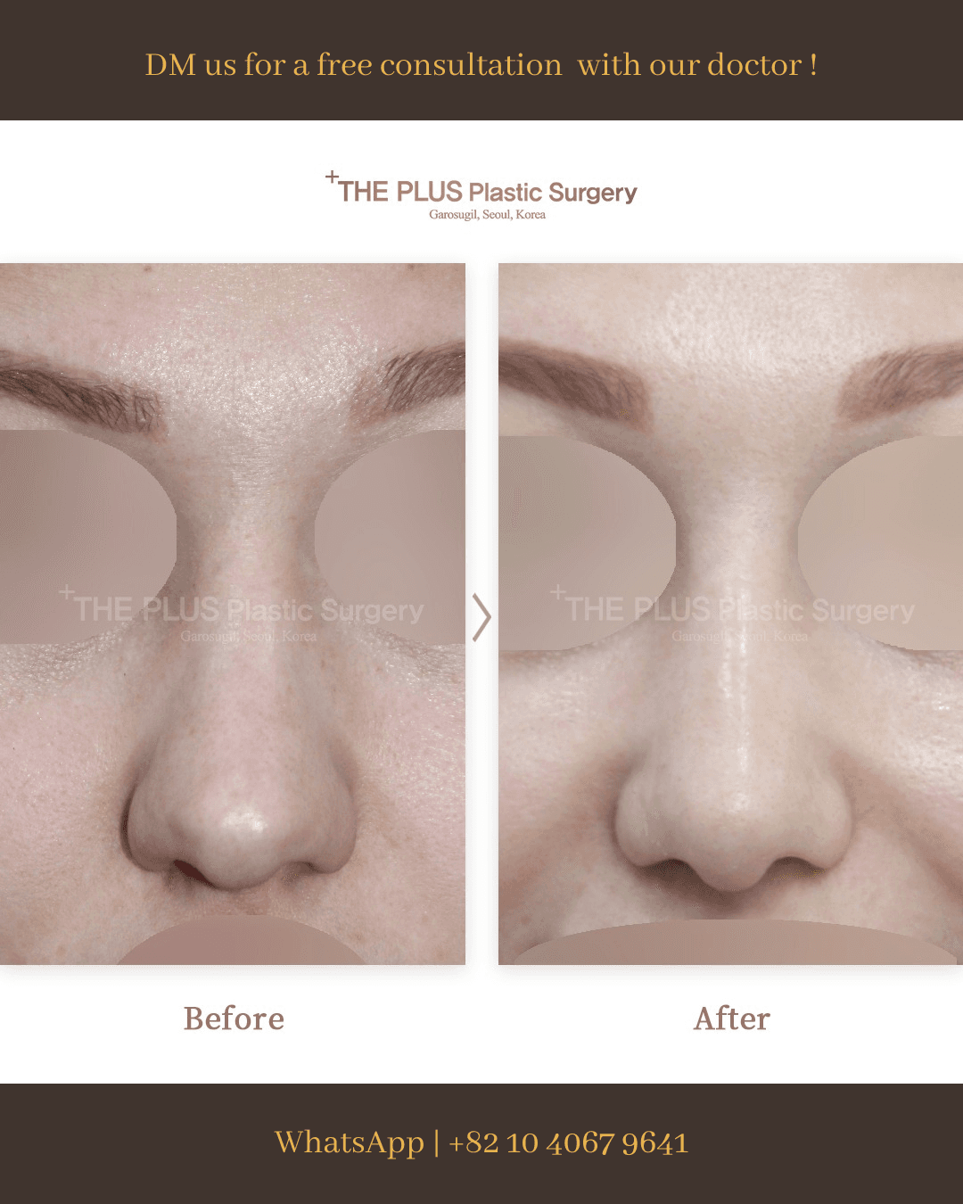 Rhinoplasty, Rhinitis Surgery