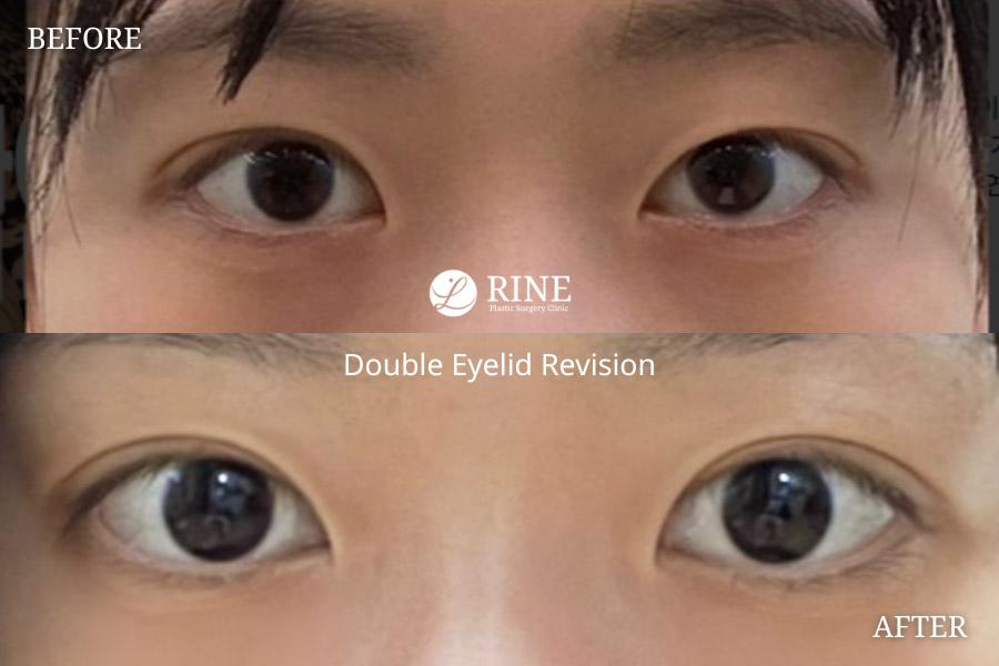 Double Eyelid revision